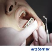 Quanto tempo demora o tratamento com aparelho ortodôntico?