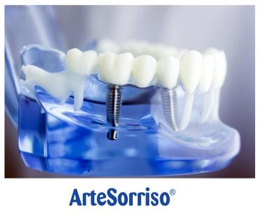 É demorado um implante dentário ?