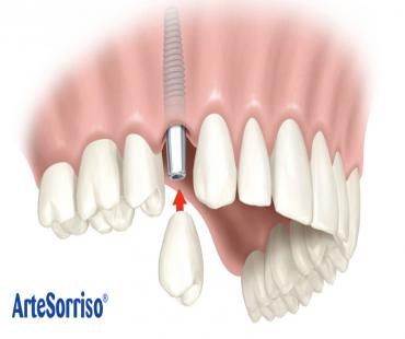 Implantes Dentários