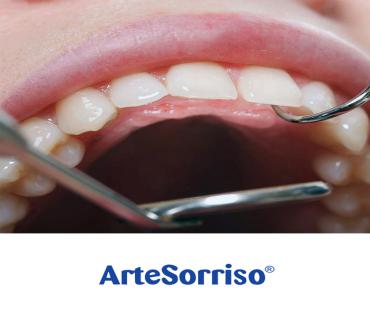 Preciso retirar os dentes sisos antes de colocar aparelho ?